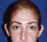 Otoplasty (Ear) Surgery