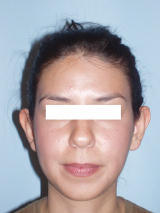 Ear Surgery (otoplasty)