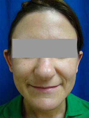 Ear Surgery (Otoplasty)