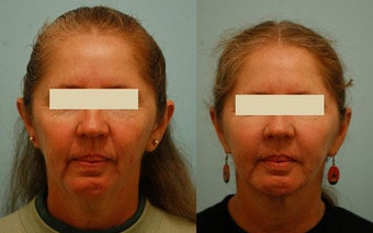 Otoplasty (Cosmetic Ear Pinning)
