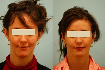 Otoplasty (Cosmetic Ear Pinning)
