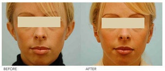 Otoplasty (Cosmetic Ear Pinning)