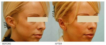 Otoplasty (Cosmetic Ear Pinning)