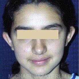 Otoplasty (ear set-back)