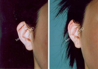 Ear Surgery