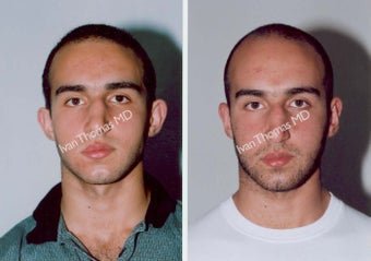 Ear Surgery - Otoplasty