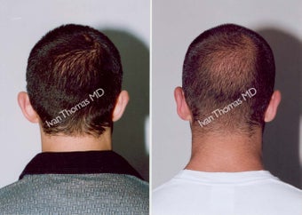 Ear Surgery - Otoplasty