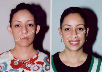 Ear Surgery - Otoplasty