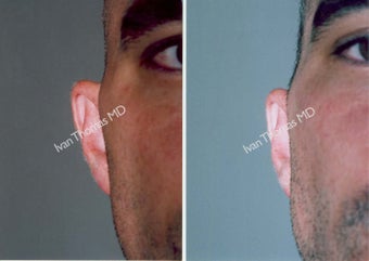 Ear Surgery - Otoplasty