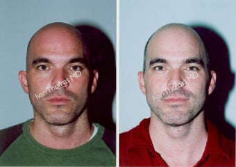 Ear Surgery - Otoplasty