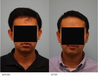 Otoplasty