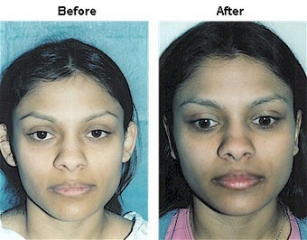 Otoplasty