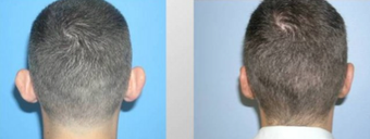 Otoplasty