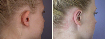 Ear Surgery