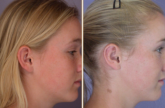 Ear Surgery
