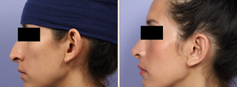 Ear Surgery