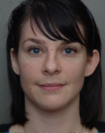 Otoplasty