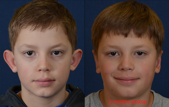 9 Year Old Male Child Treated for Prominent Ears