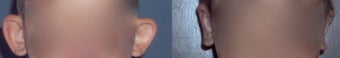 Otoplasty
