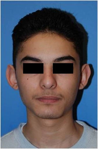 Before and after Otoplasty / Ear Reshaping