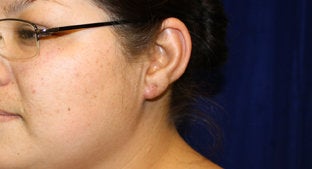 Ear lobe Keloid 