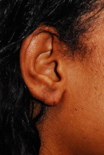 Earlobe Repair