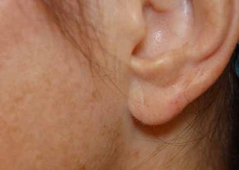 Earlobe Repair