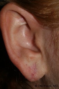 Earlobe Repair