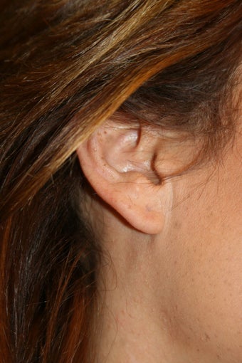 Ear Lobe Repair