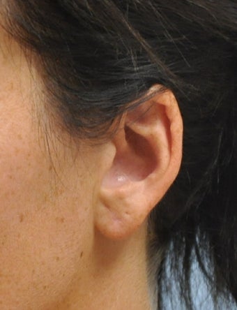 Ear Lobe Repair