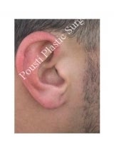 Earlobe Repair Surgery