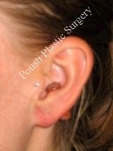 Earlobe Repair Surgery