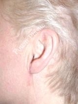 Earlobe Repair Surgery