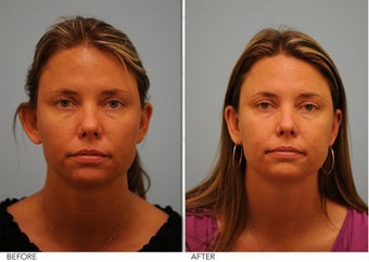 Otoplasty