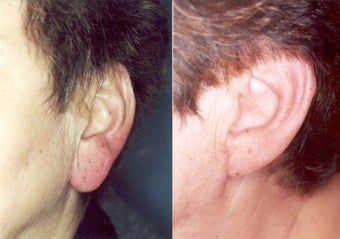 Lobularplasty