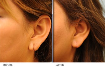 Torn earlobe repair