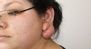 Ear lobe Keloid 