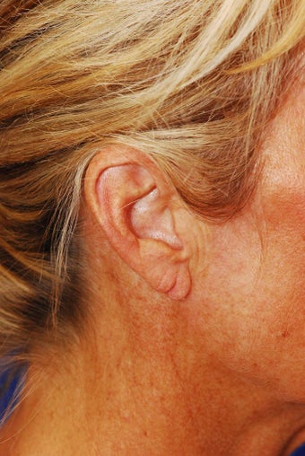 Earlobe Repair