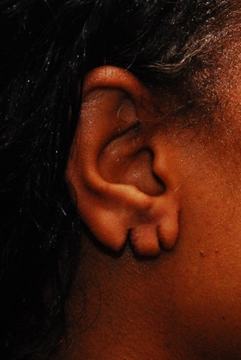 Earlobe Repair