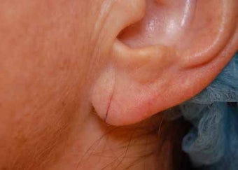 Earlobe Repair