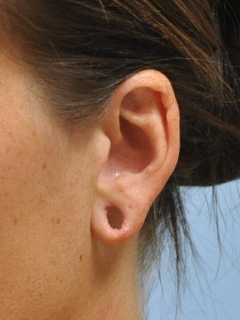 Ear Lobe Repair