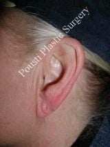 Earlobe Repair Surgery