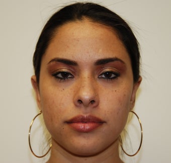 Otoplasty