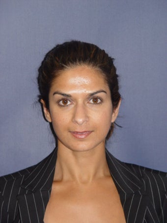 Otoplasty