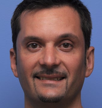 Otoplasty
