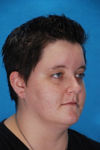 Ear Lobe Reconstruction