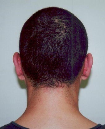 Otoplasty - Bilateral protruding ears