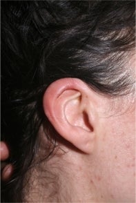 Otoplasty