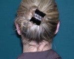 Ear Pinning