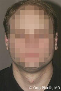 Otoplasty